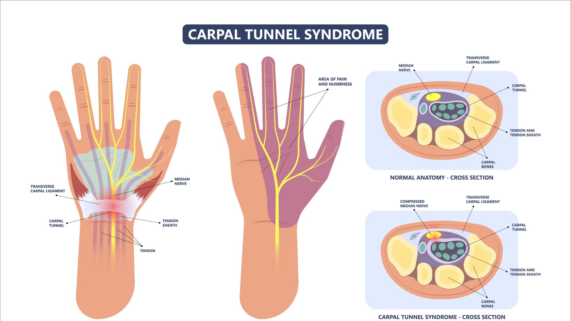 The Warning Signs Of Carpal Tunnel Syndrome The Warning Signs Of Carpal Tunnel Syndrome