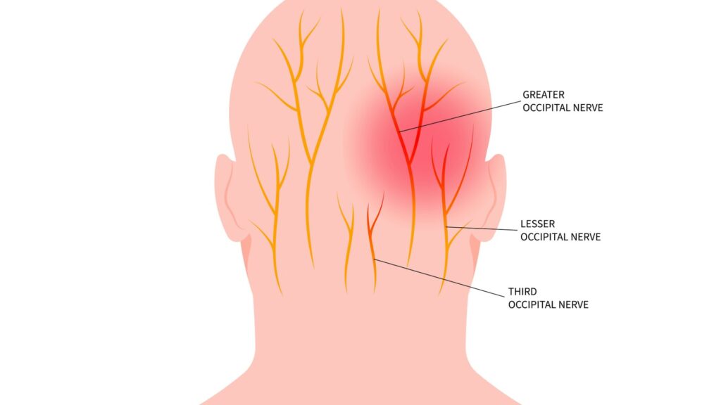 Can a Chiropractor Treat Occipital Neuralgia? 1 occipital neuralgia chiropractor 19202741080