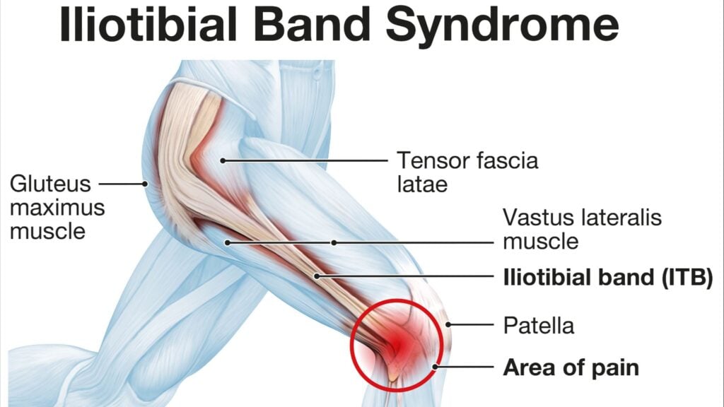 Can You Do Chiropractic for TFL and IT Band Syndrome? 1 tfl it band 19204381080
