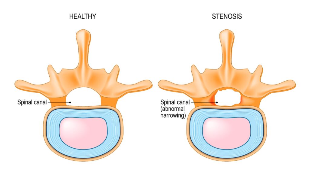 Can Spinal Stenosis Kill You? 1 can spinal stenosis kill 19205221080