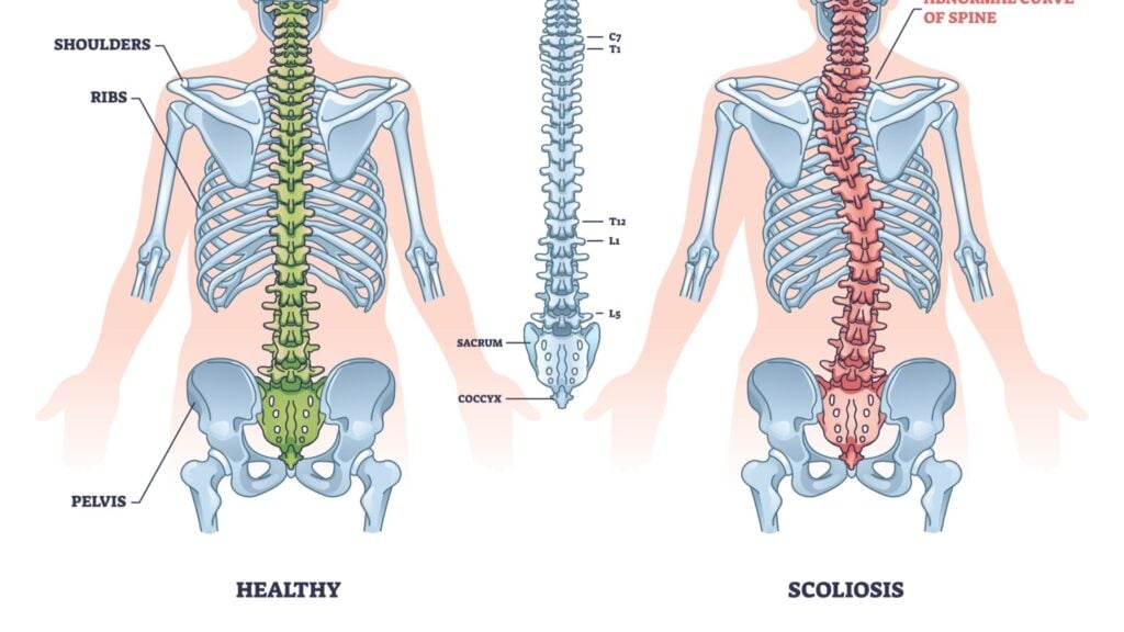 scoliosis_19205231080 scoliosis 19205231080