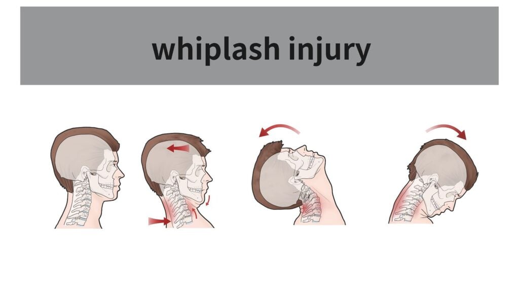 How Chiropractic Care Can Help With Whiplash Injuries 1 whiplash chiropractic 1920221080