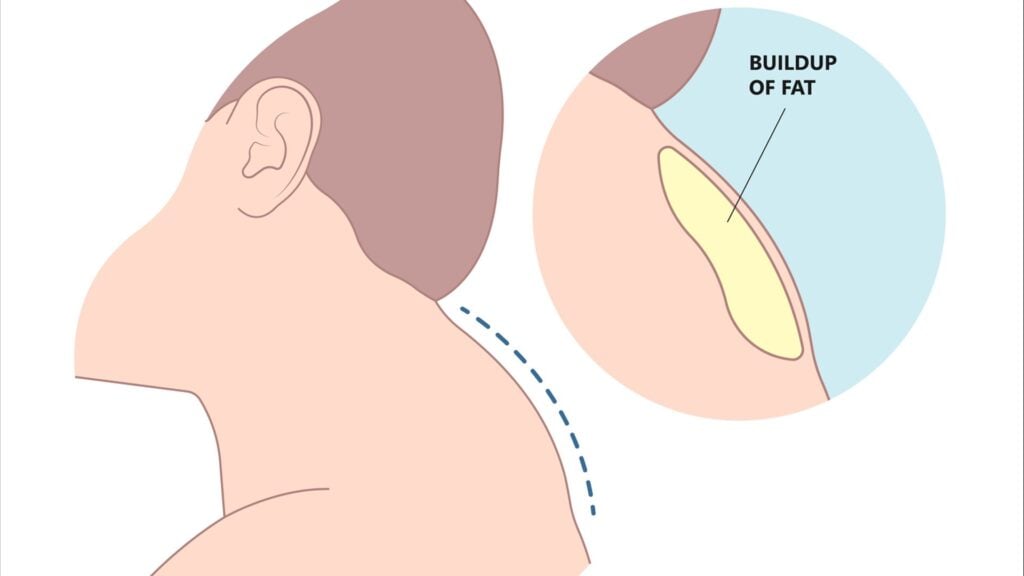 What Is Buffalo Hump and How Can Chiropractic Help? 1 buffalo hump 1920541080